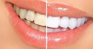 Alta White Teeth – commenti – ingredienti – erboristeria – come si usa – composizione